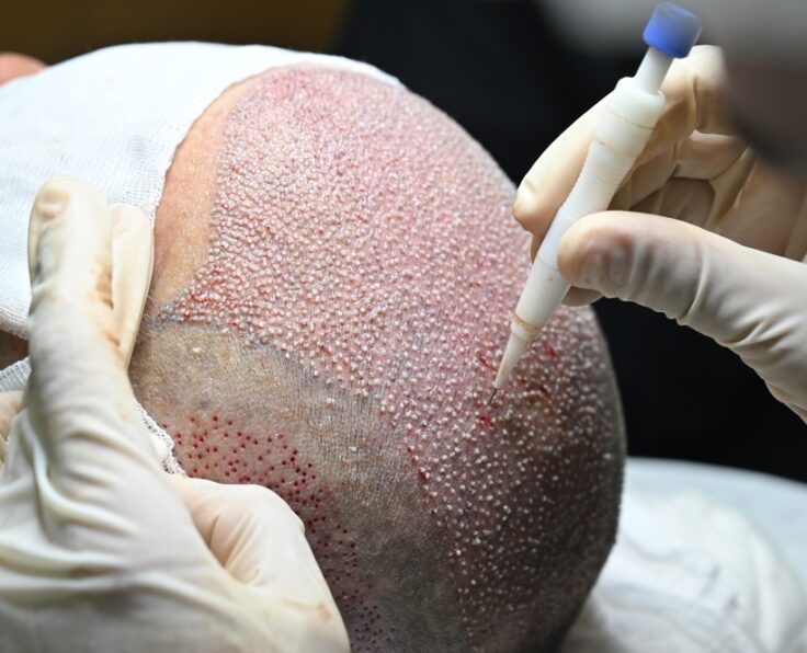 Hair,Transplantation,With,Dhi,Technique