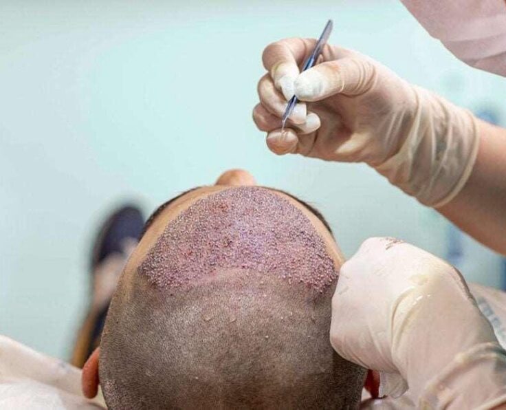 Hair-transplant-surgery-1200x628-facebook-1200x628