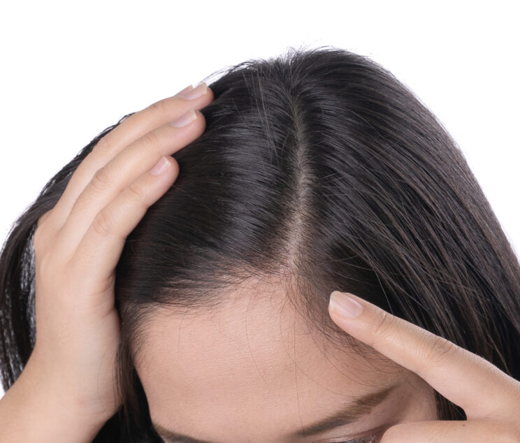 young-asian-women-worry-about-problem-hair-loss-head-bald-dandruff